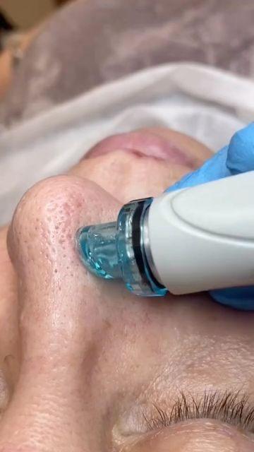 Hydrafacial