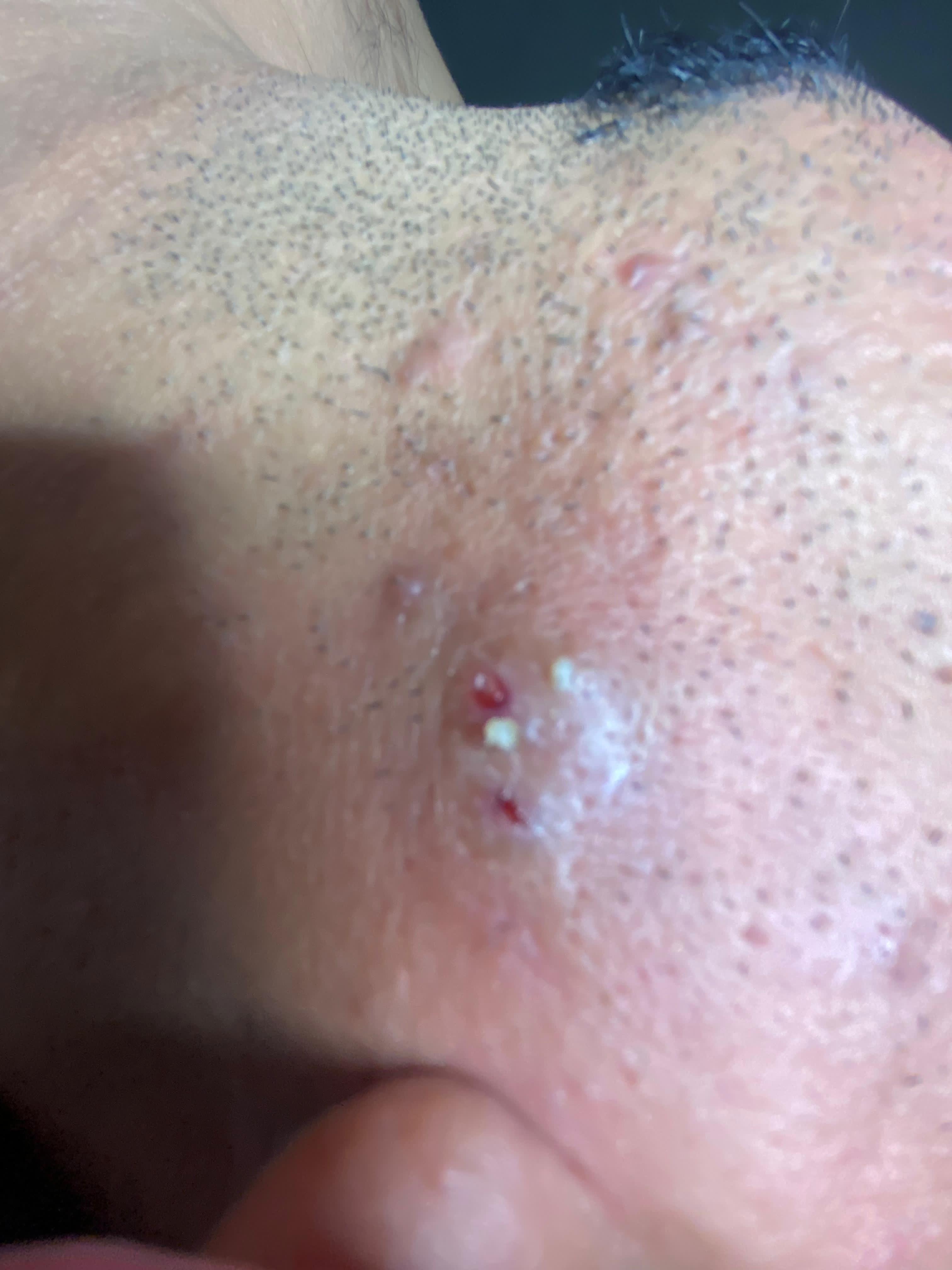 Acne Treatment