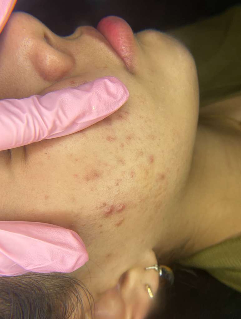 Acne Control